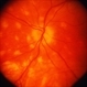 Birdshot Retinochoroidopathy